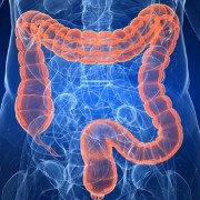 Diverticulitis related image